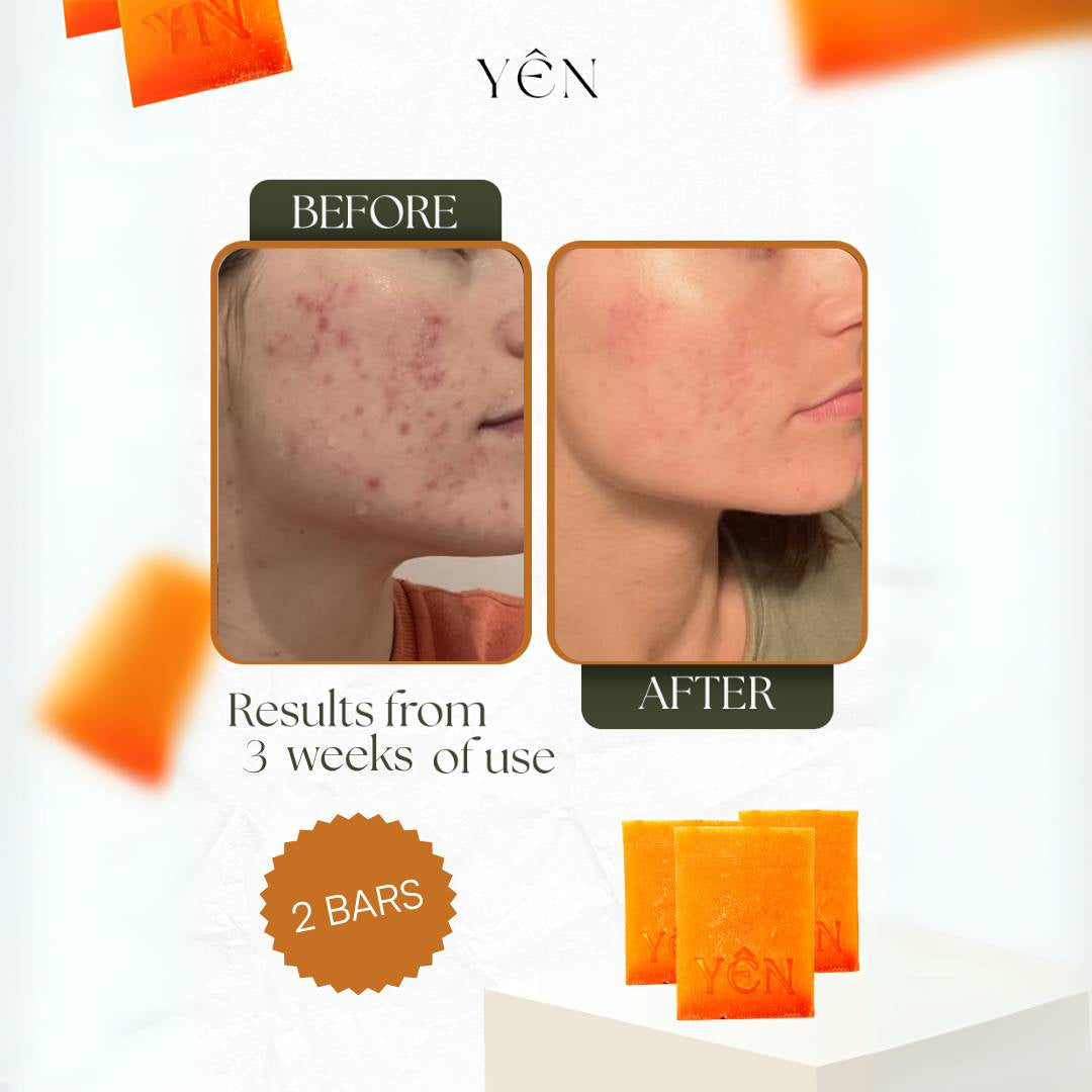 Skin Clearing Honey & Turmeric Bar